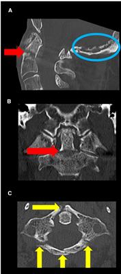 Case report: Interdisciplinary treatment of complex C1/C2 fractures in a patient with concomitant three-vessel coronary artery disease requiring bypass surgery